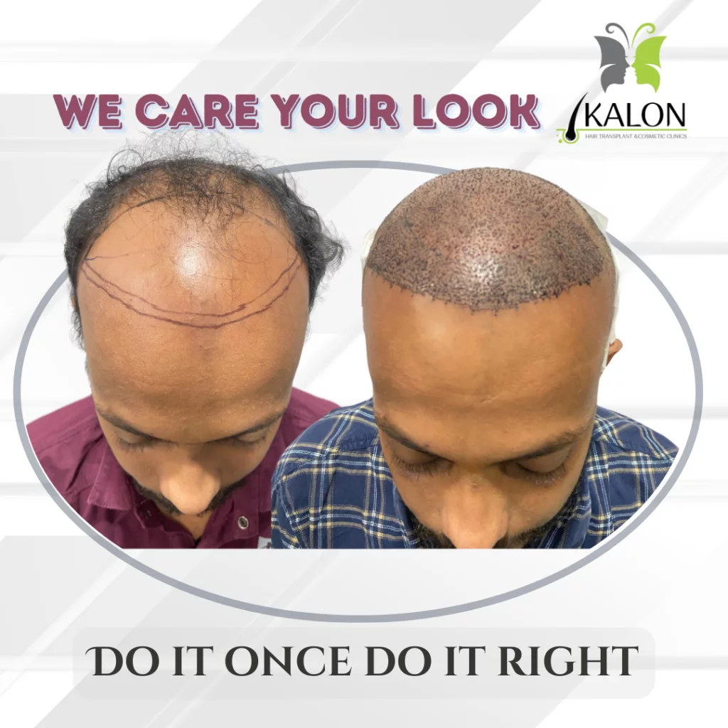 best hair transplant clinic in Hyderabad