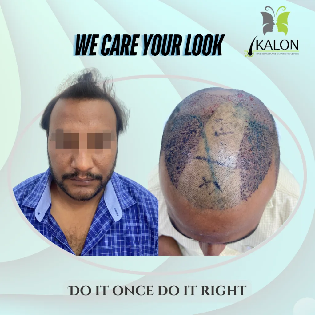 best hair transplant clinic in hyderabad