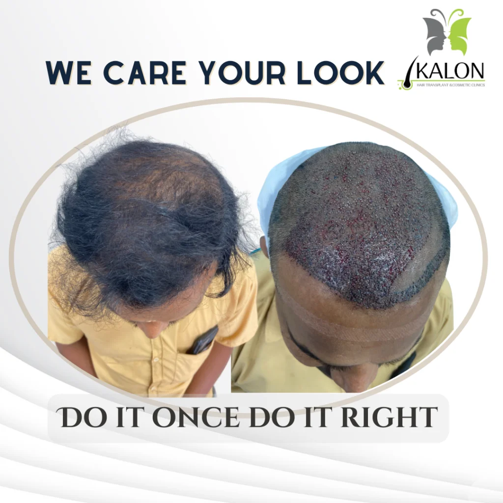 best hair transplant clinic in hyderabad
