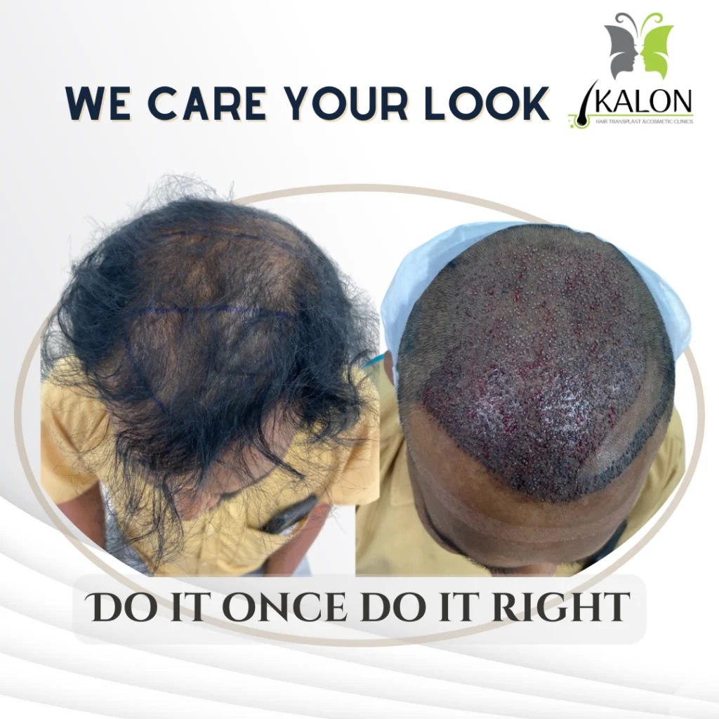 best hair transplant clinic in hyderabad
