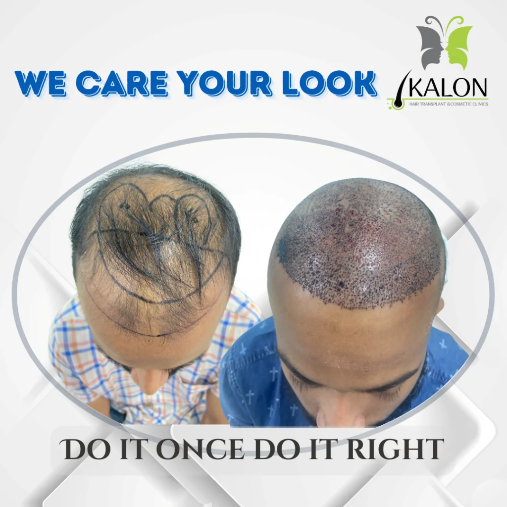 best hair transplant clinic in hyderabad