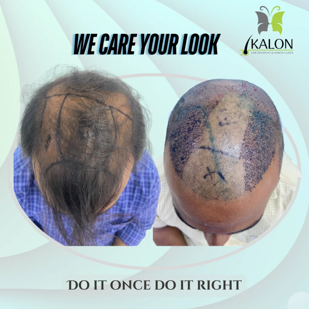 best hair transplant clinic in hyderabad