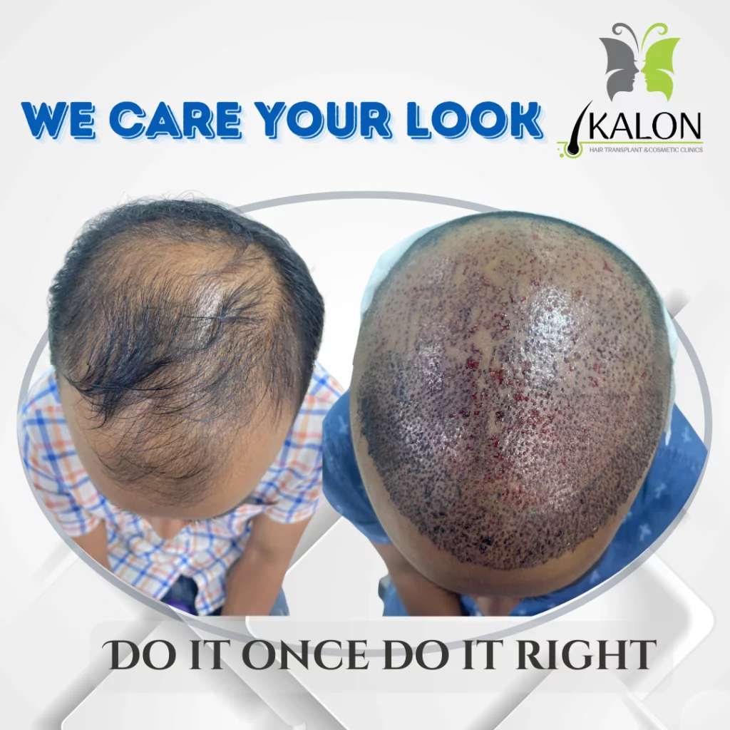 best hair transplant clinic in hyderabad