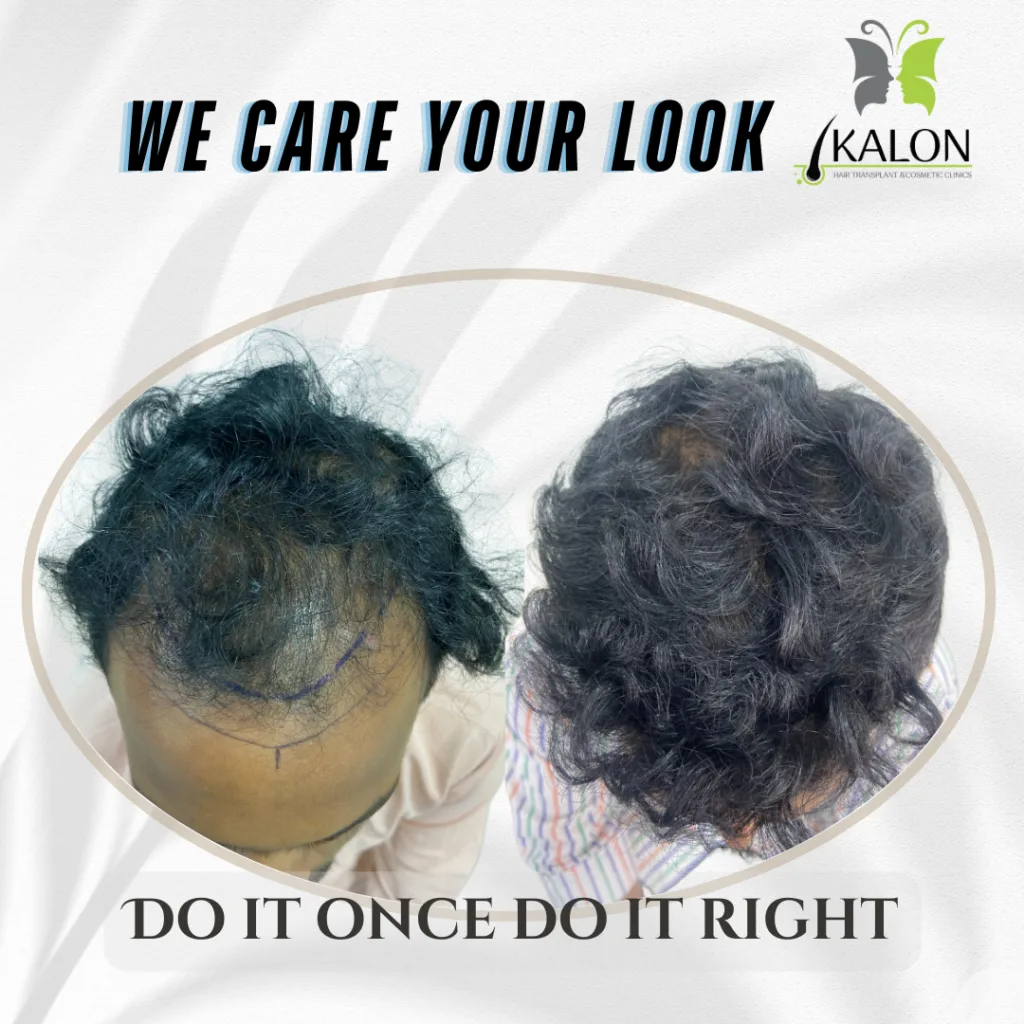 best hair transplant clinic in hyderabad