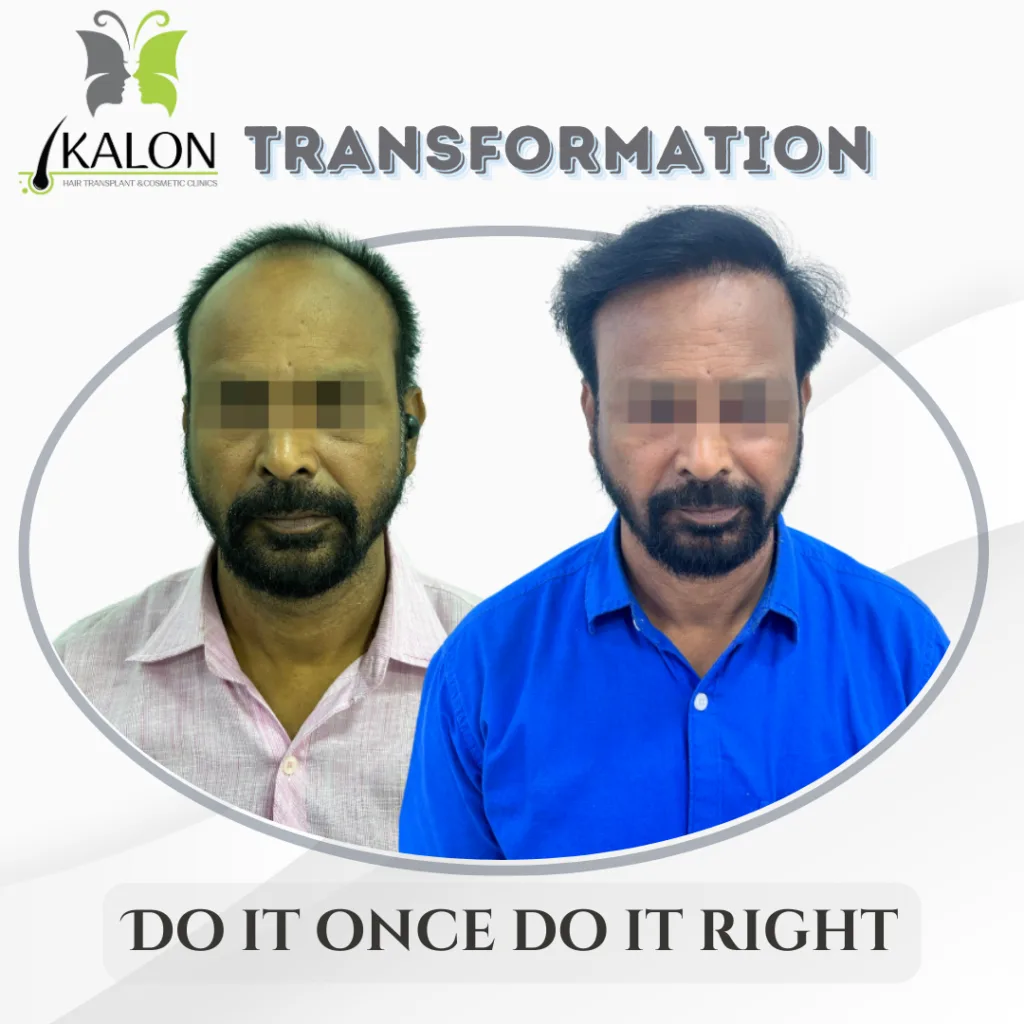 best hair transplant in visakhapatnam