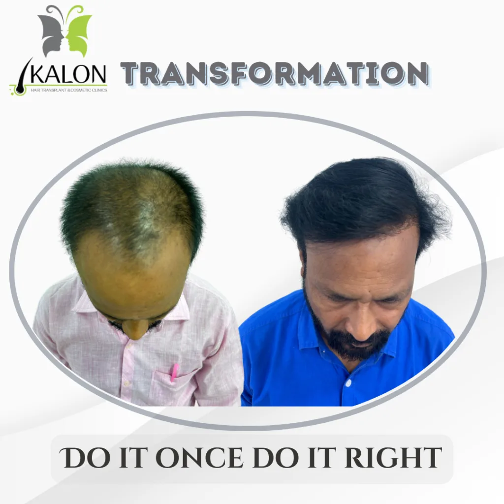 best hair transplant in hyderabad