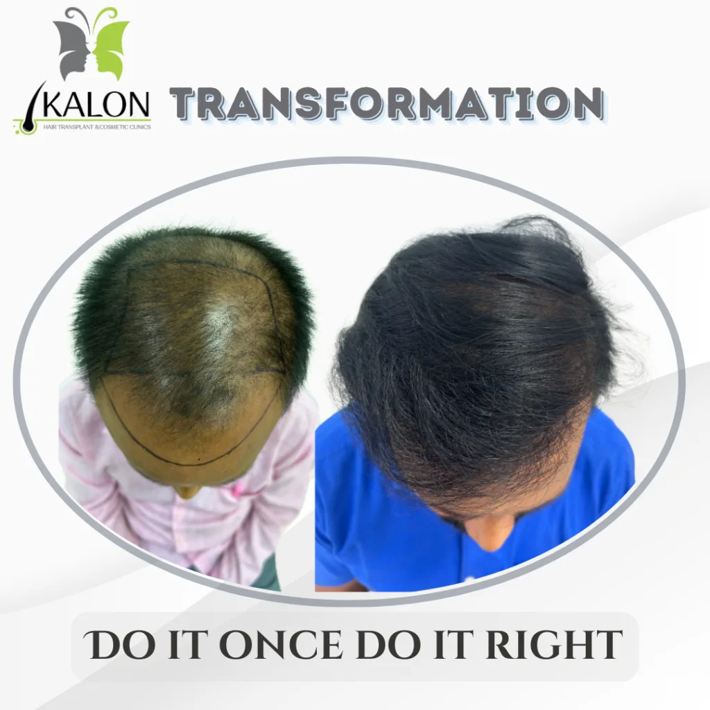 best hair transplant in hyderabad