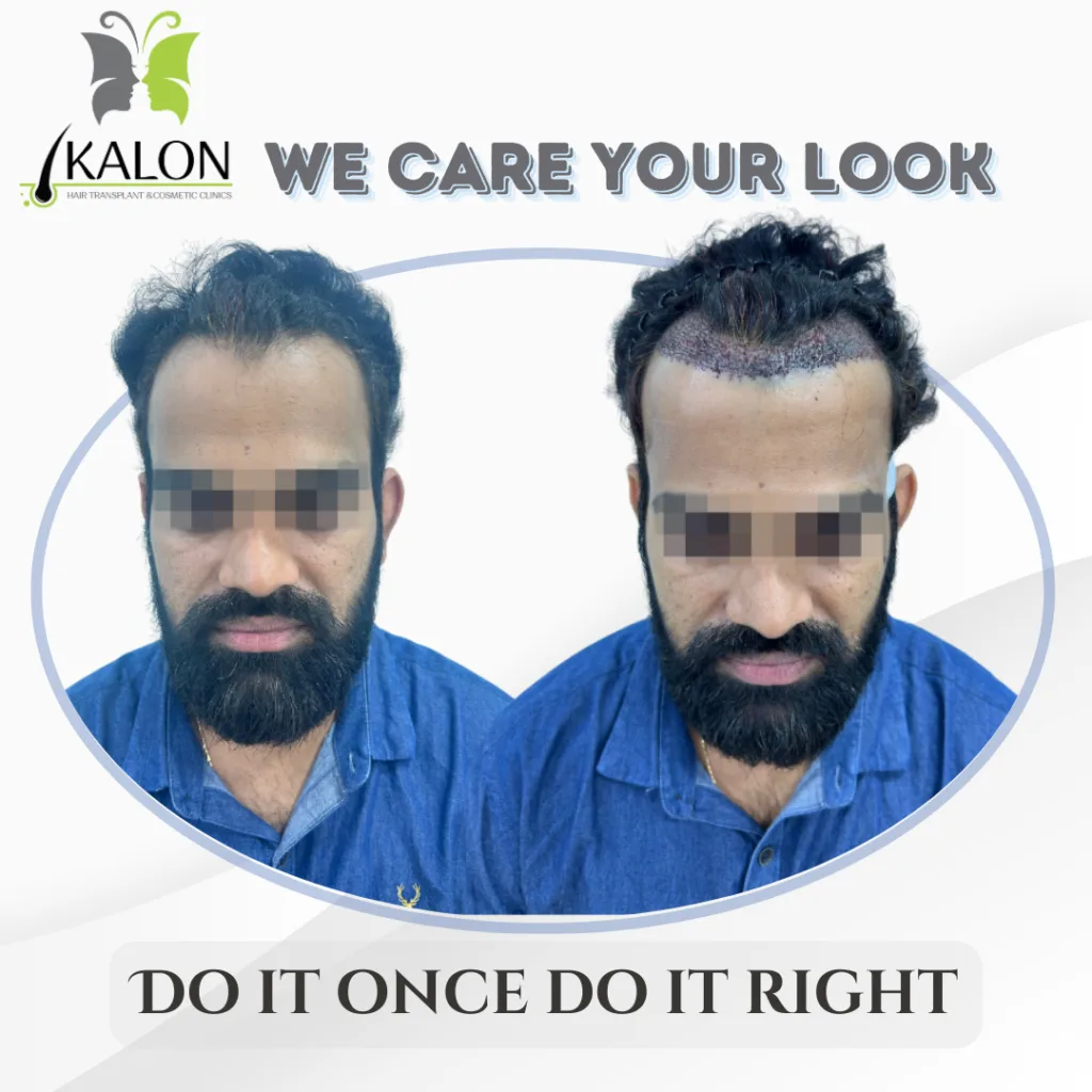 best hair transplant clinic in visakhapatnam