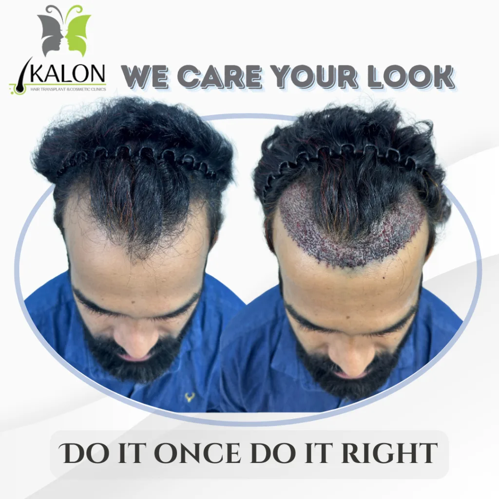 best hair transplant clinic in visakhapatnam