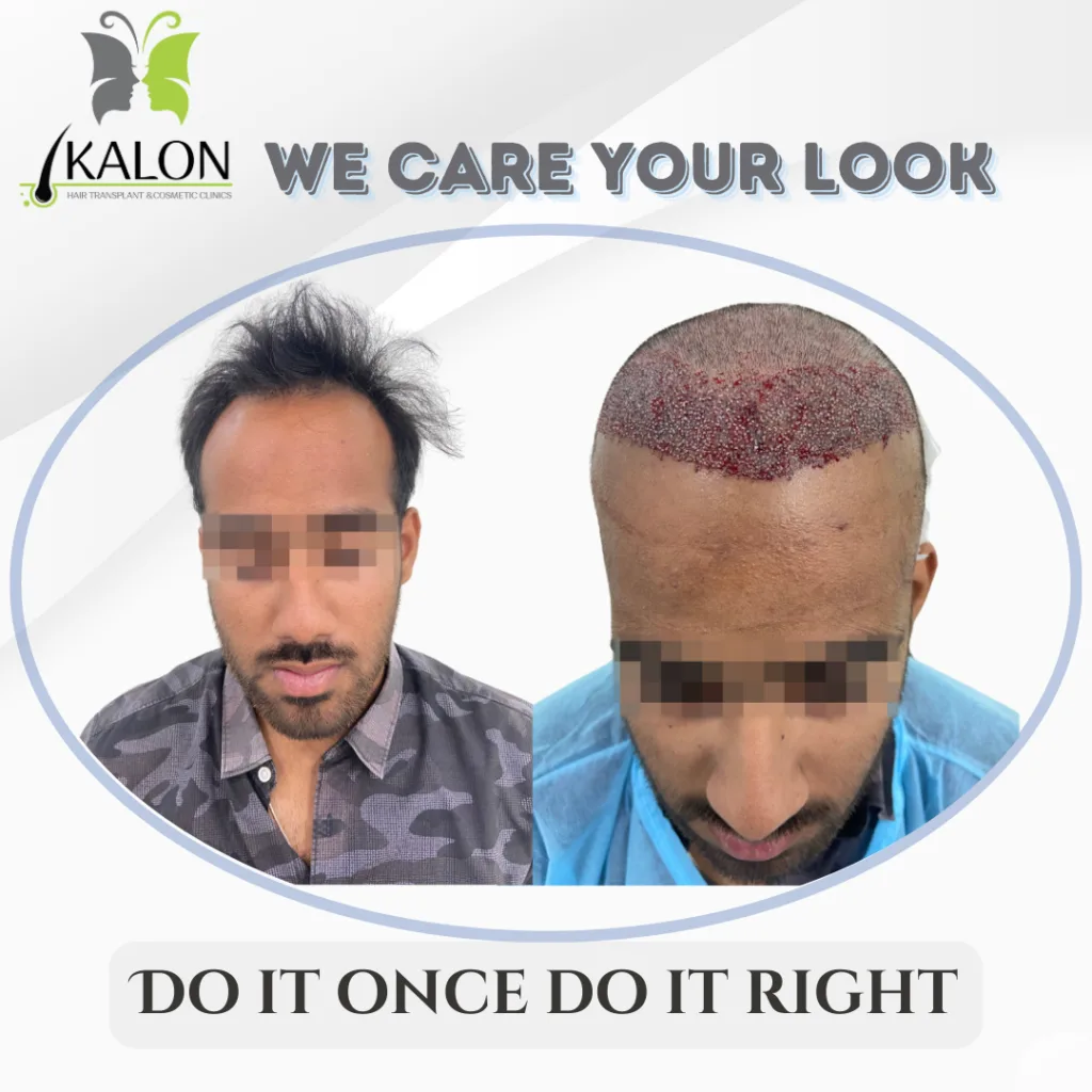 best hair transplant clinic in visakhapatnam