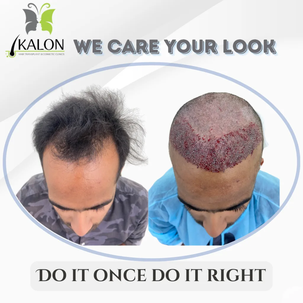 best hair transplant clinic in visakhapatnam