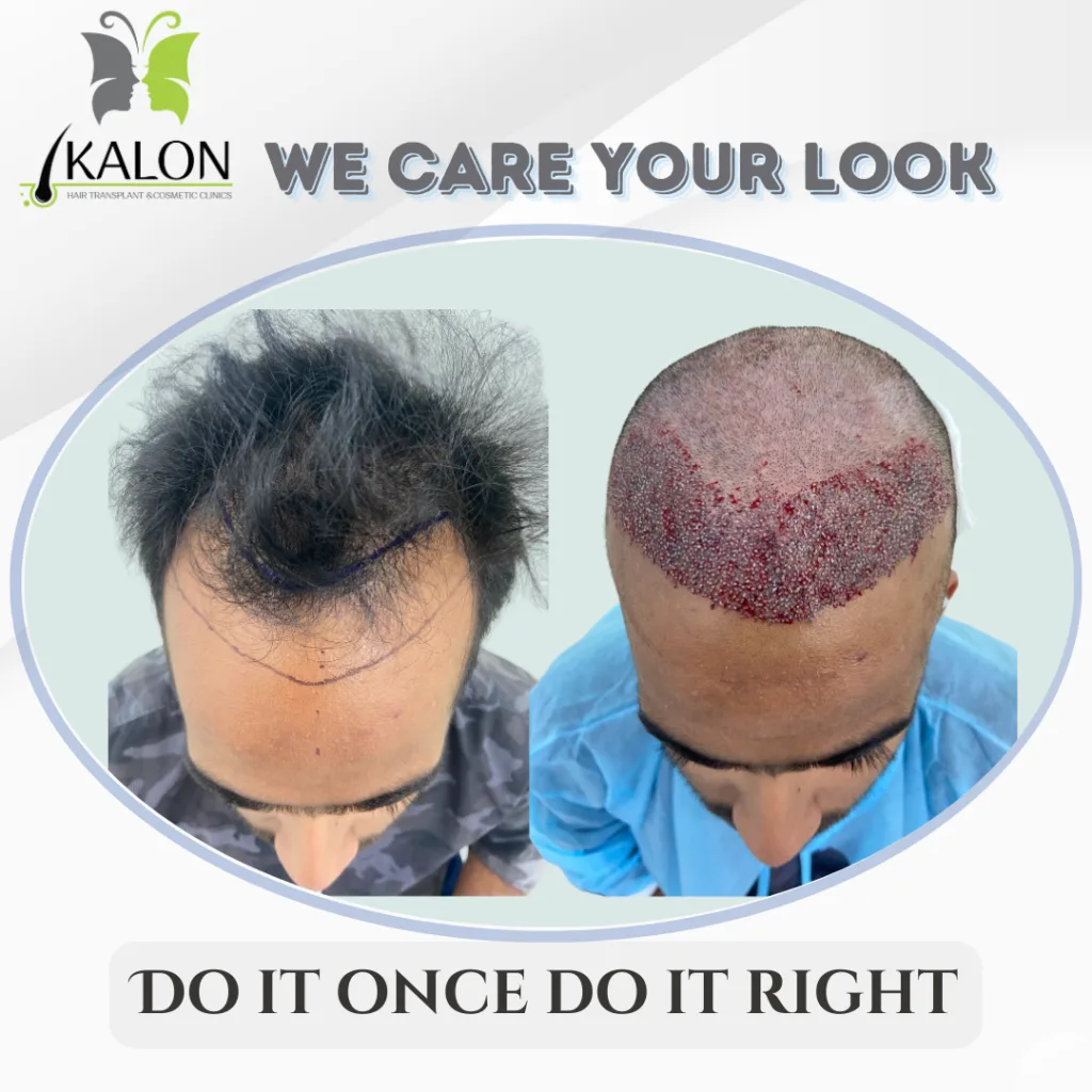 best hair transplant clinic in visakhapatnam