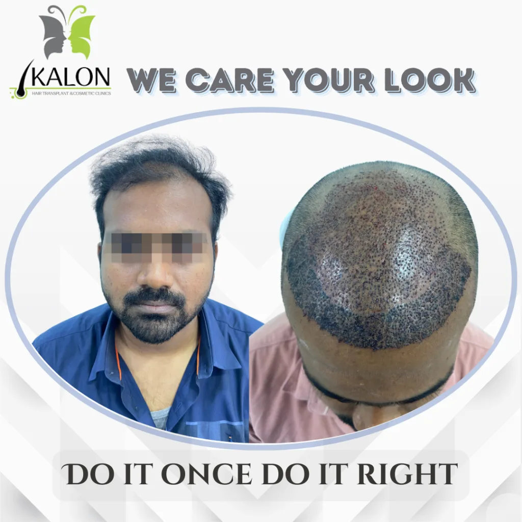 best hair transplant clinic in visakhapatnam