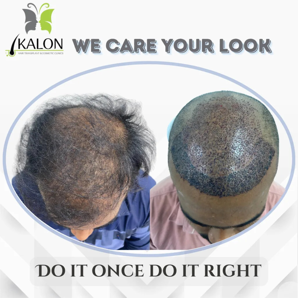 best hair transplant clinic in visakhapatnam