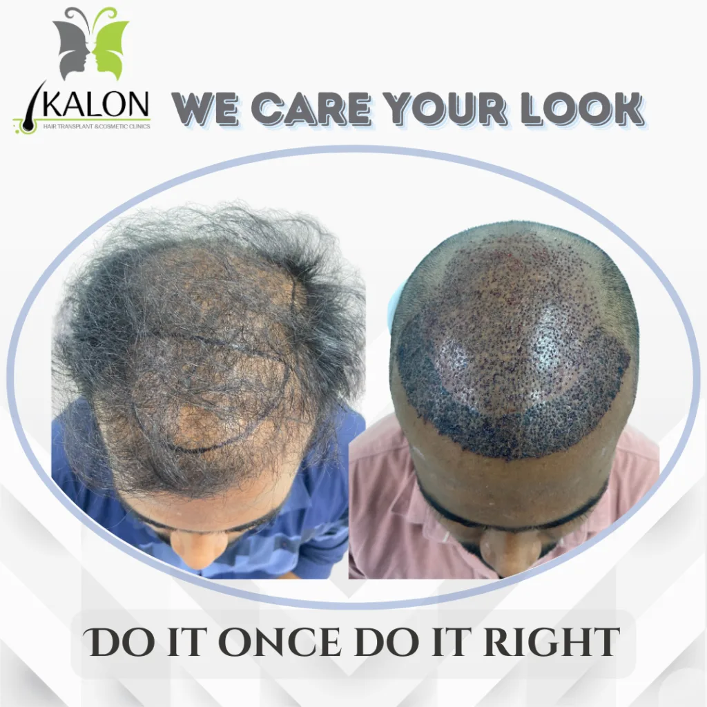 best hair transplant clinic in visakhapatnam