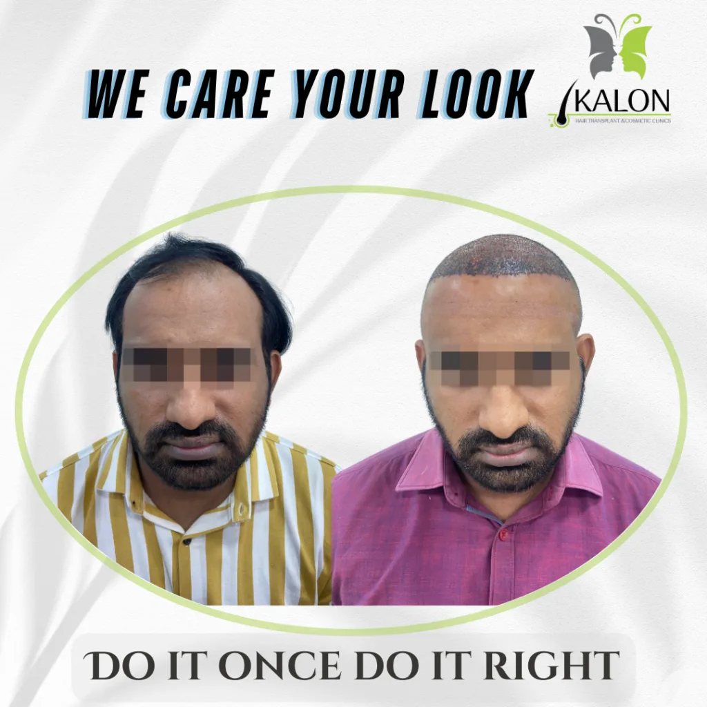 best hair transplant clinic in visakhapatnam