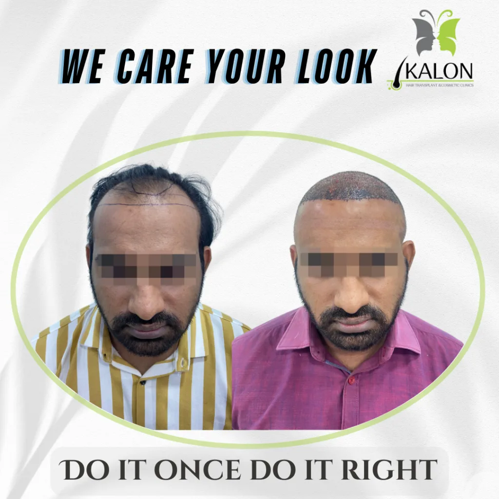 best hair transplant clinic in visakhapatnam
