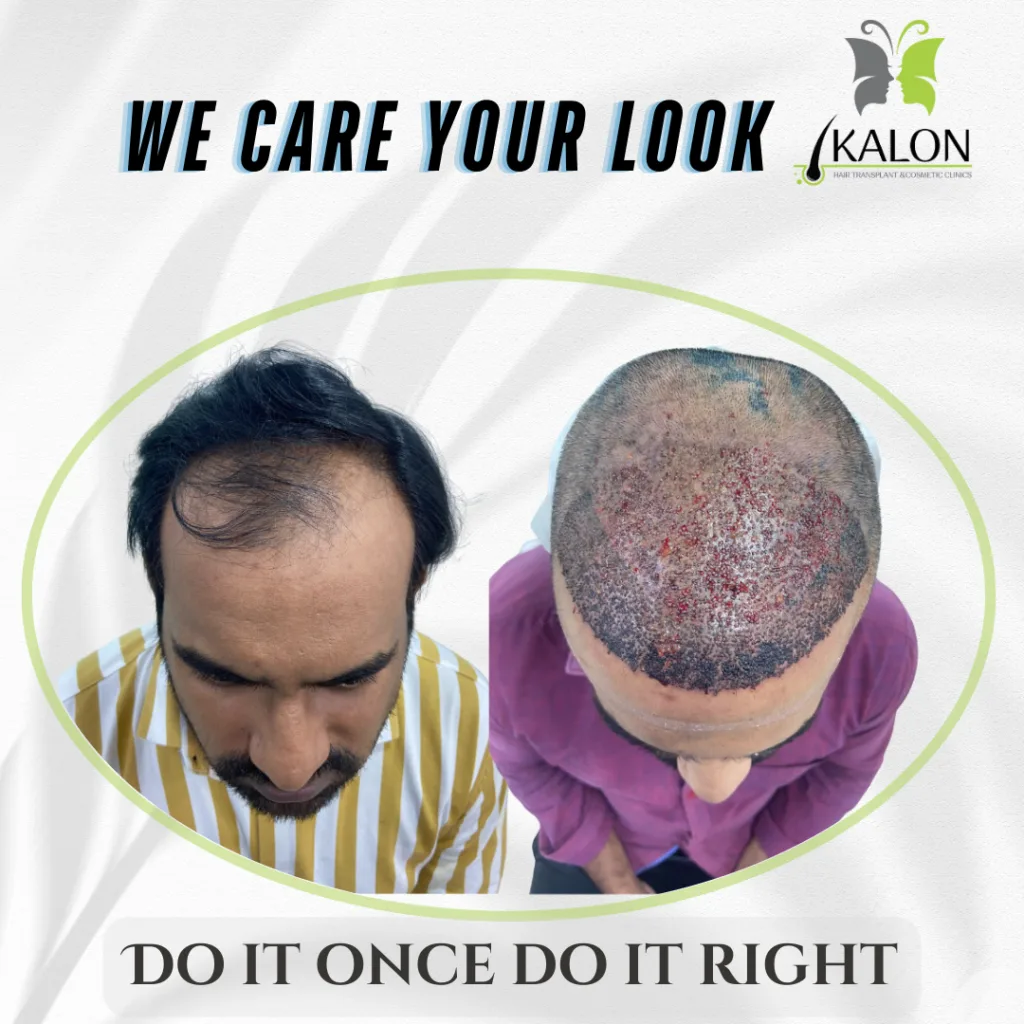 best hair transplant clinic in visakhapatnam