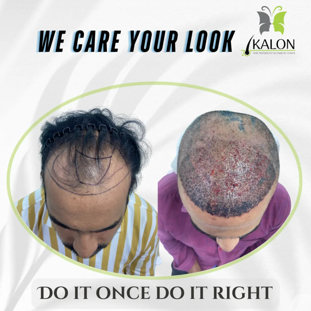 best hair transplant clinic in hyderabad