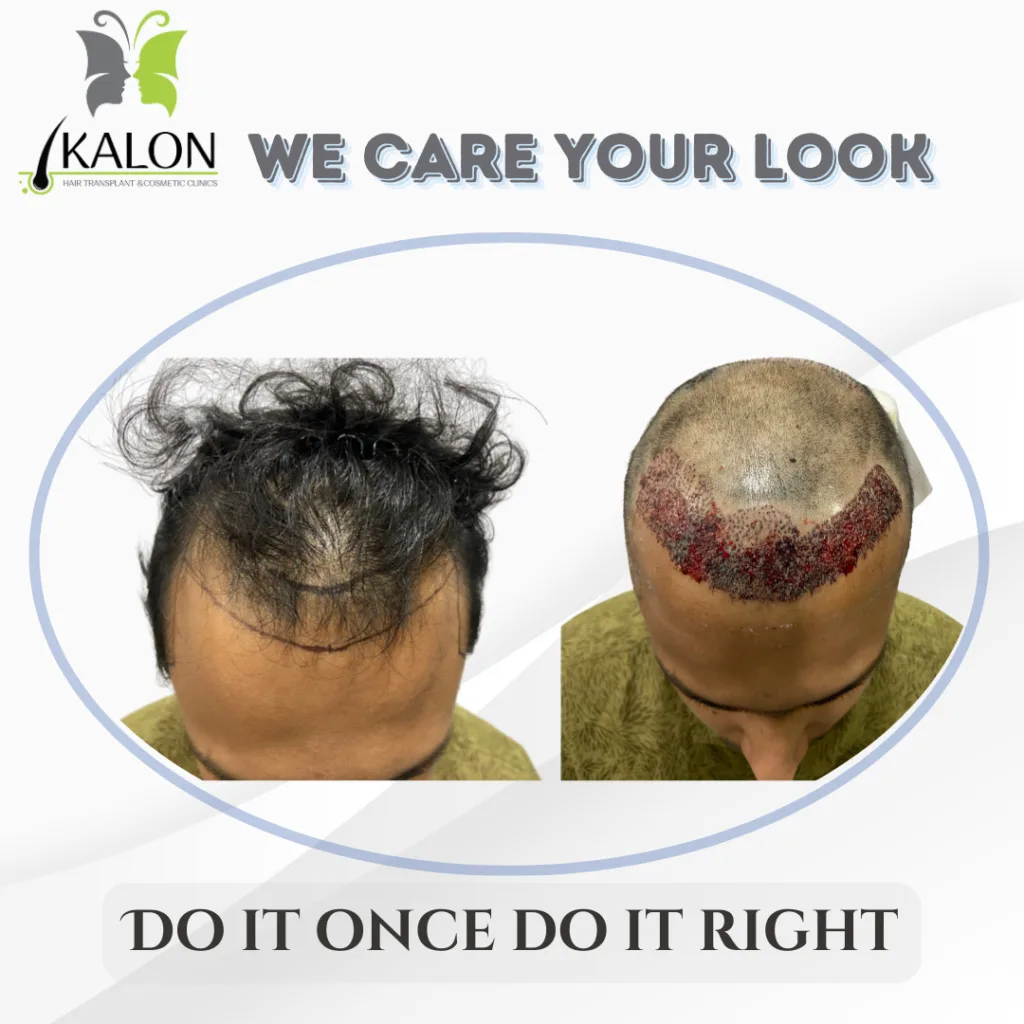 best hair transplant clinic in visakhapatnam 
