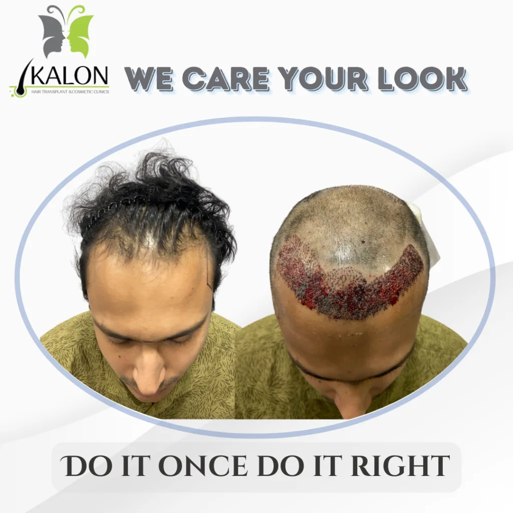best hair transplant clinic in visakhapatnam