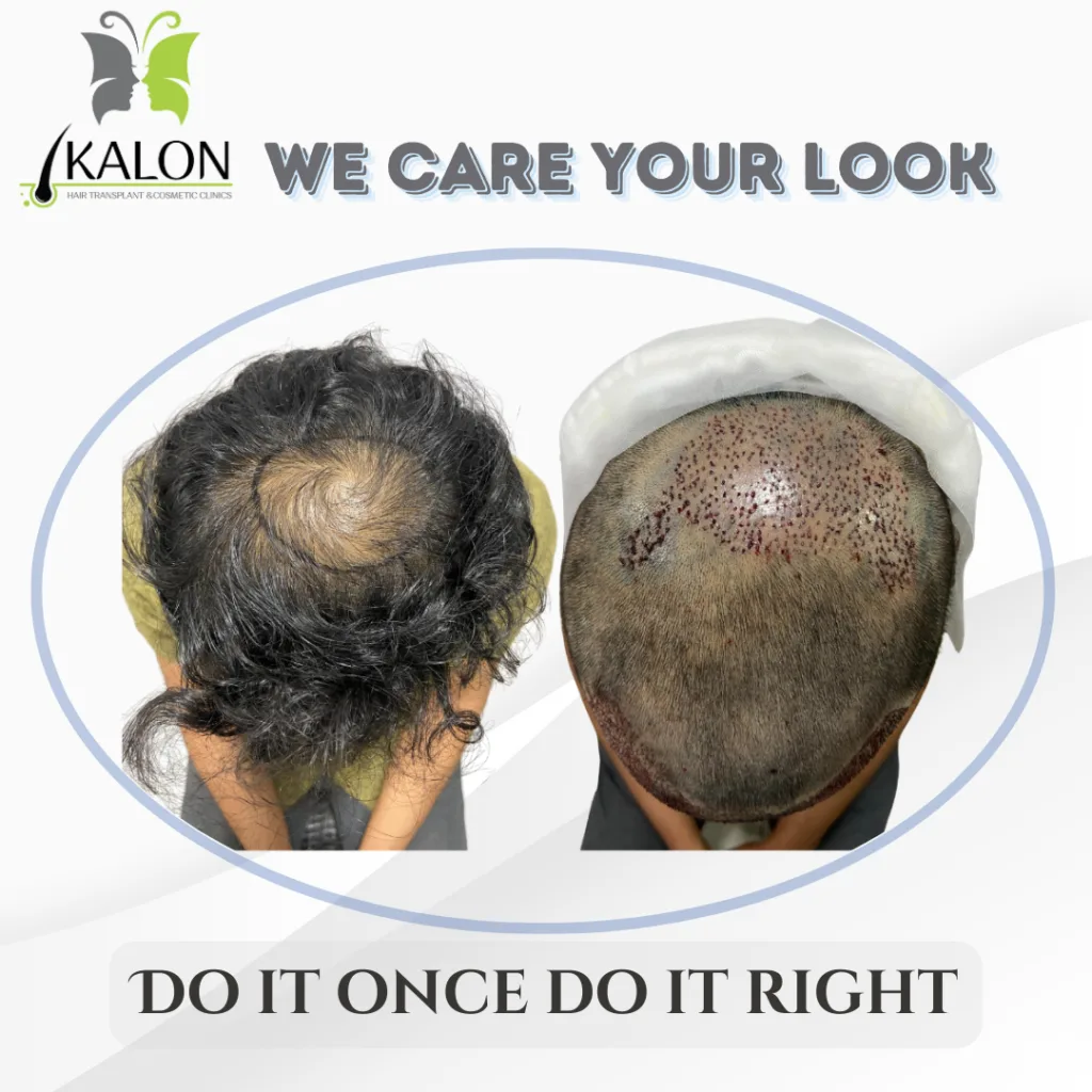 best hair transplant clinic in hyderabad