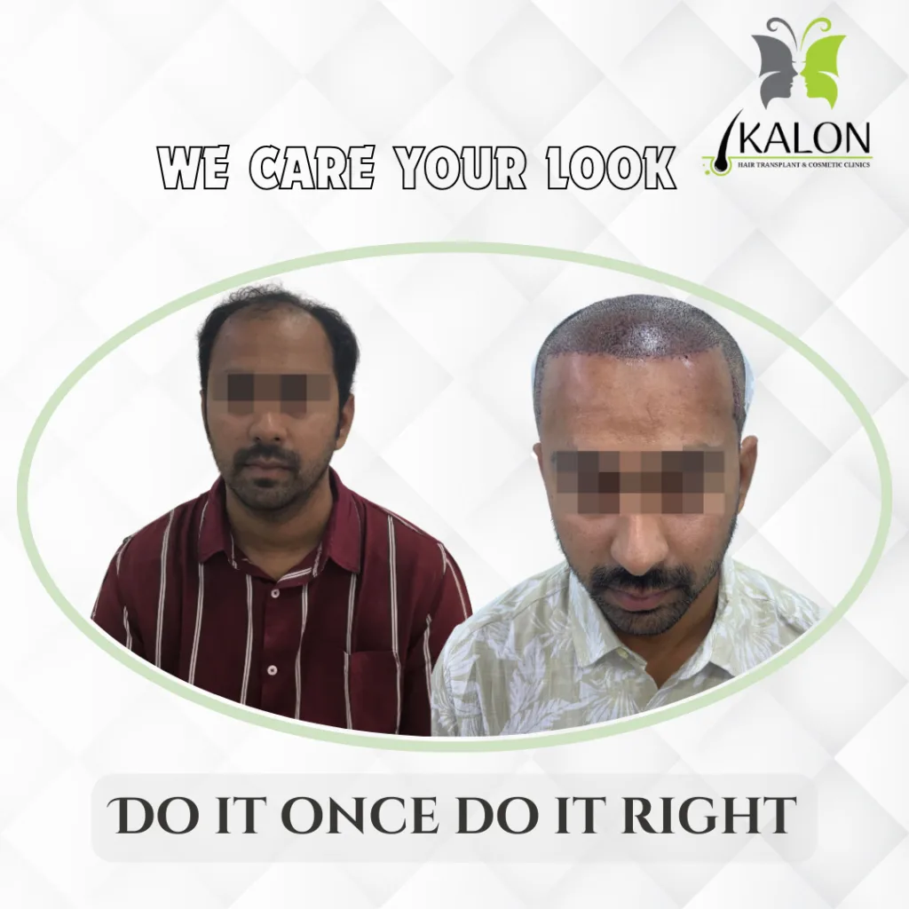 best hair transplant clinic in visakhapatnam