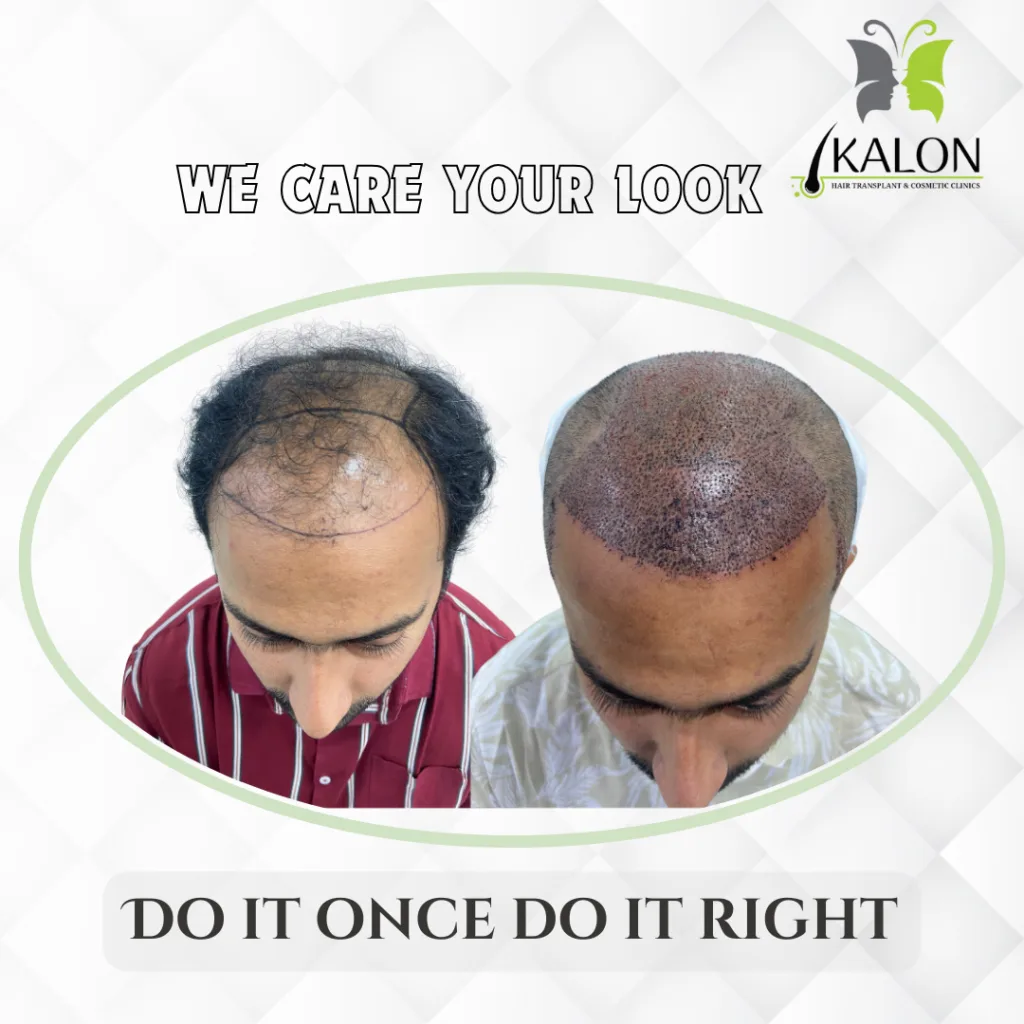 best hair transplant clinic in visakhapatnam