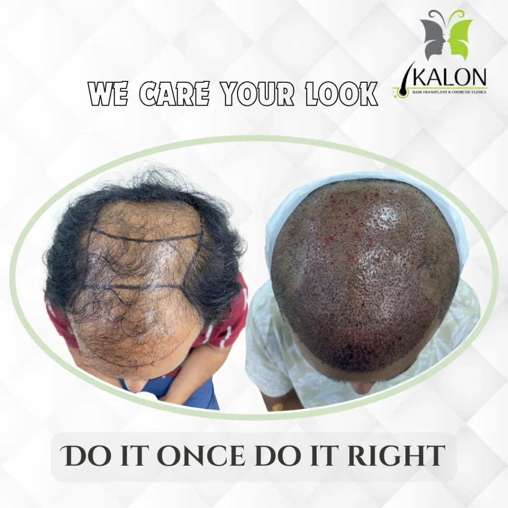 best hair transplant clinic in visakhapatnam