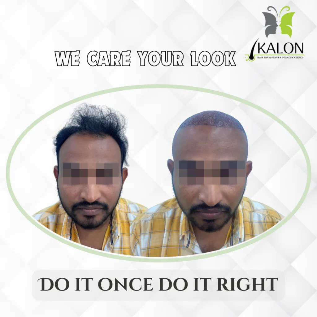 best hair transplant clinic in visakhapatnam
