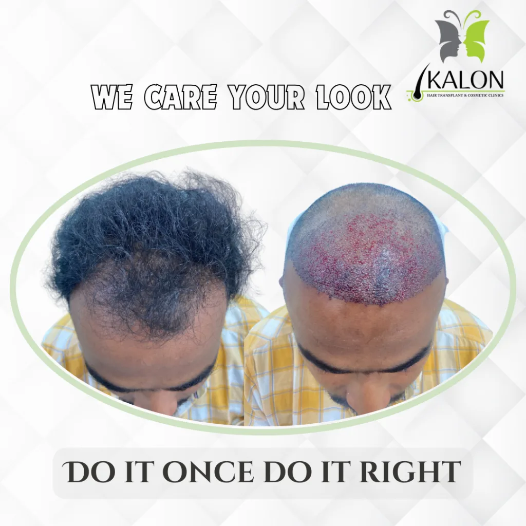 best hair transplant clinic in visakhapatnam