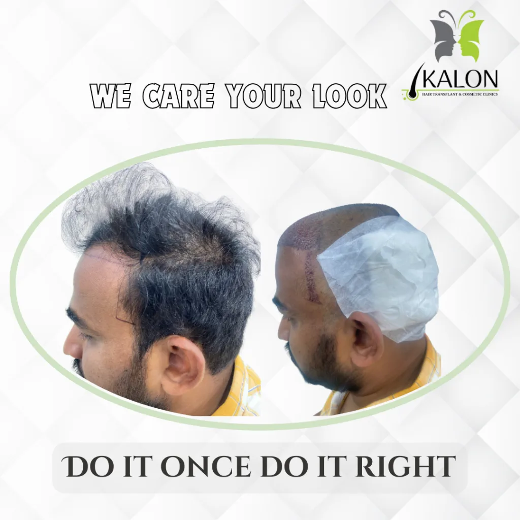 best hair transplant clinic in visakhapatnam