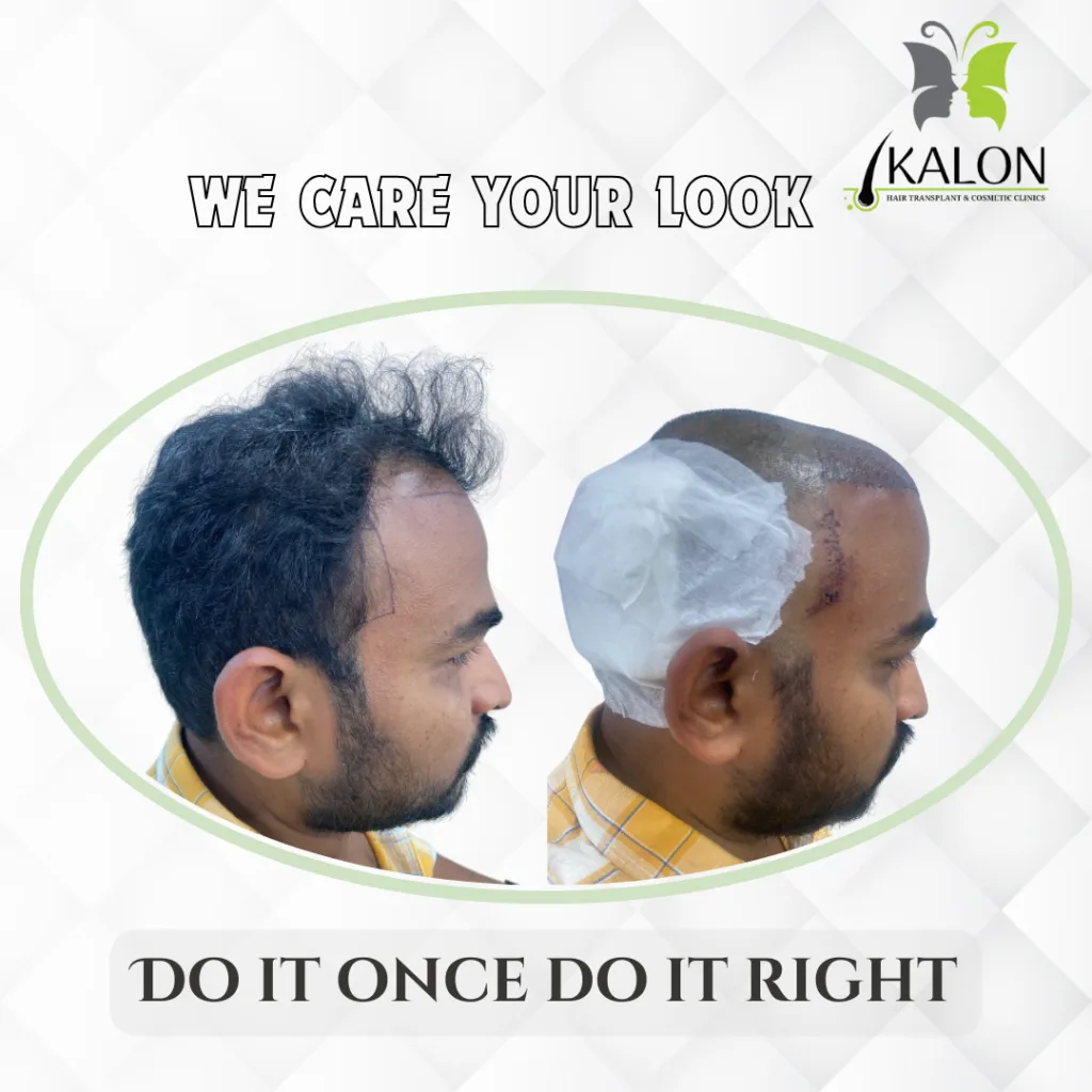 best hair transplant clinic in visakhapatnam