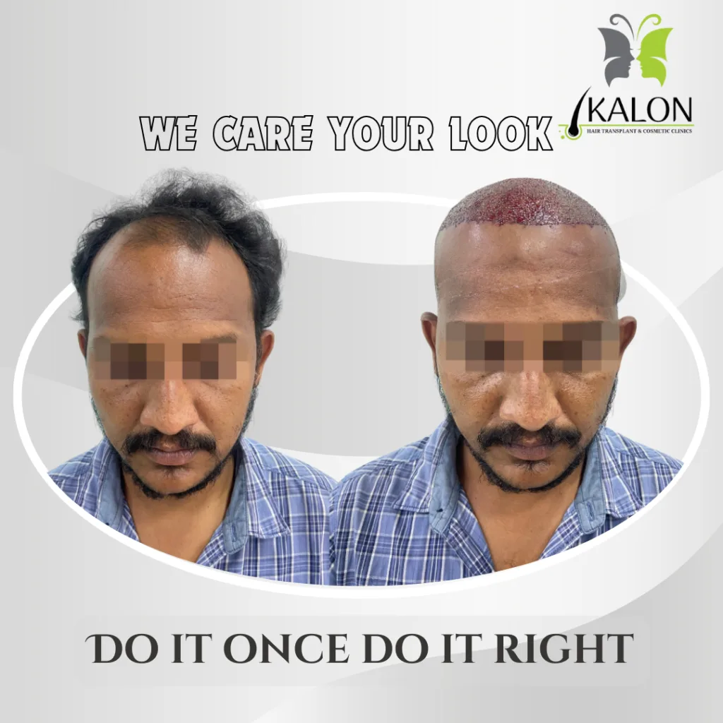 best hair transplant clinic in visakhapatnam