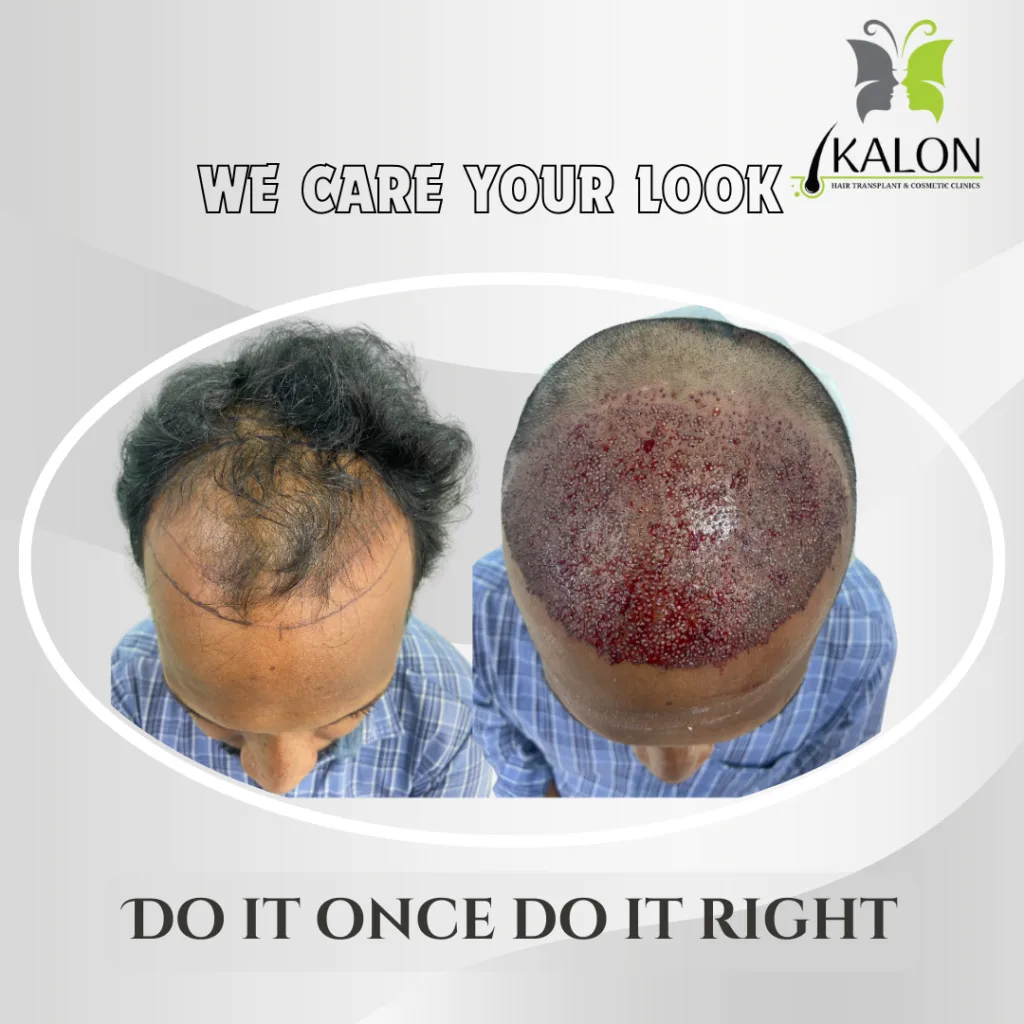 best hair transplant clinic in visakhapatnam