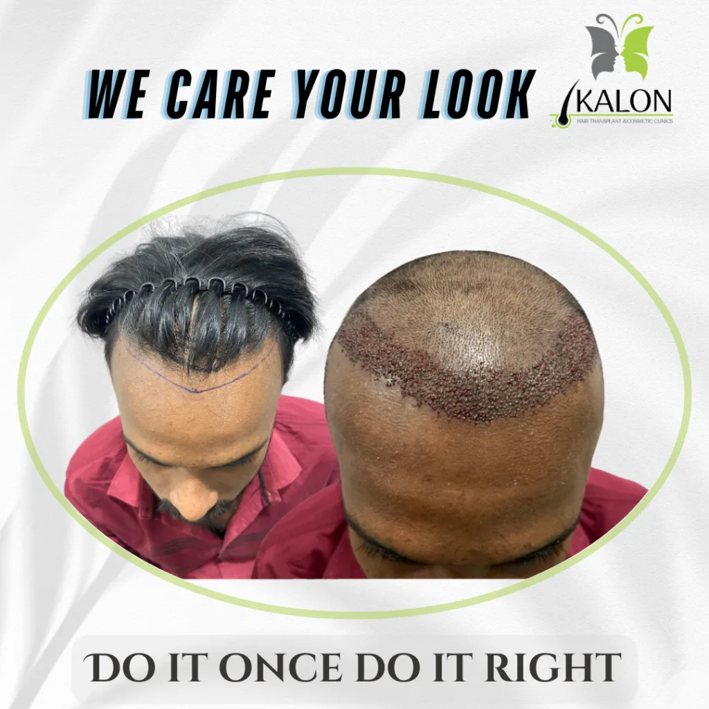 best hair transplant clinic in visakhapatnam