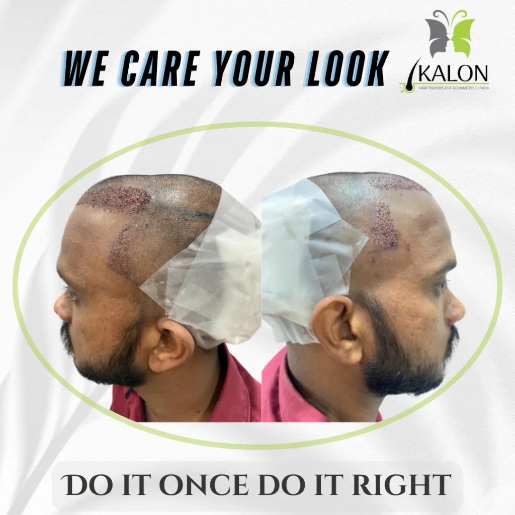 best hair transplant clinic in visakhapatnam