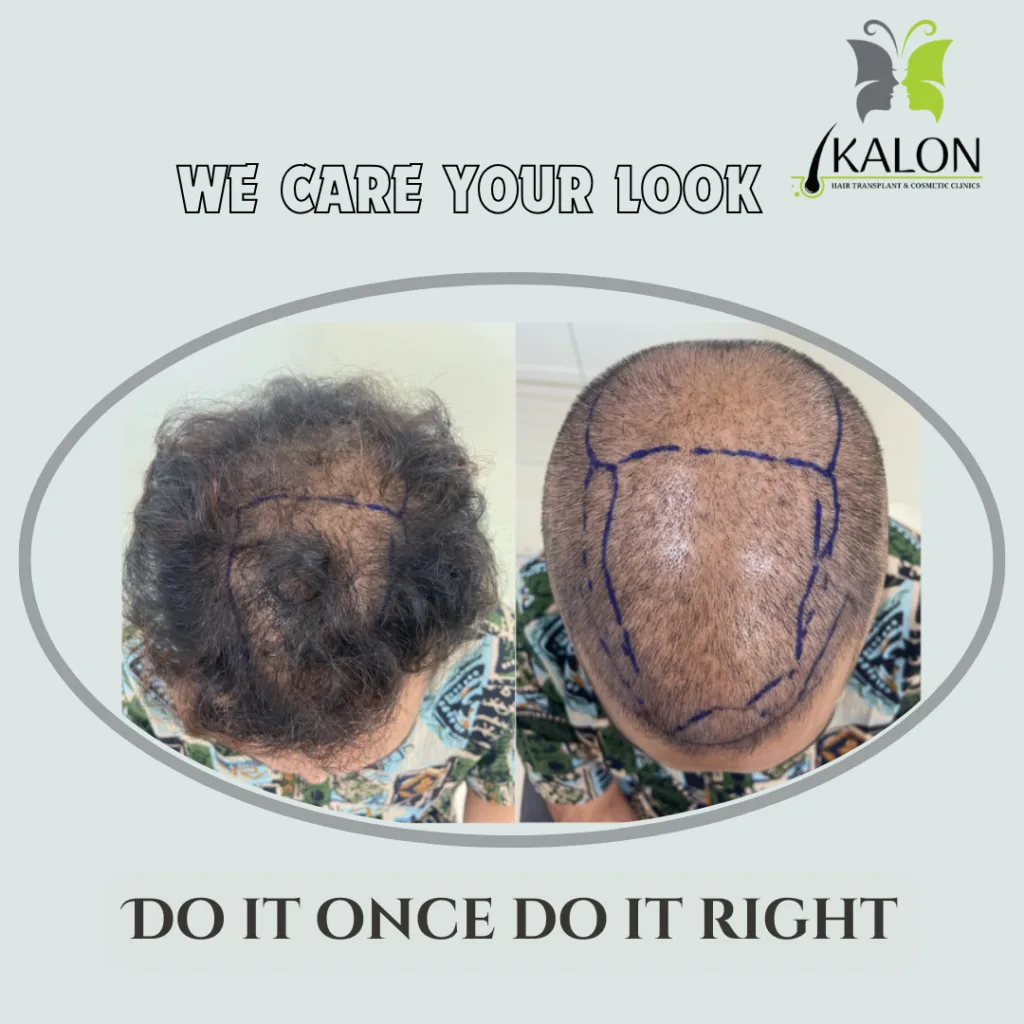 best hair transplant in visakhapatnam
