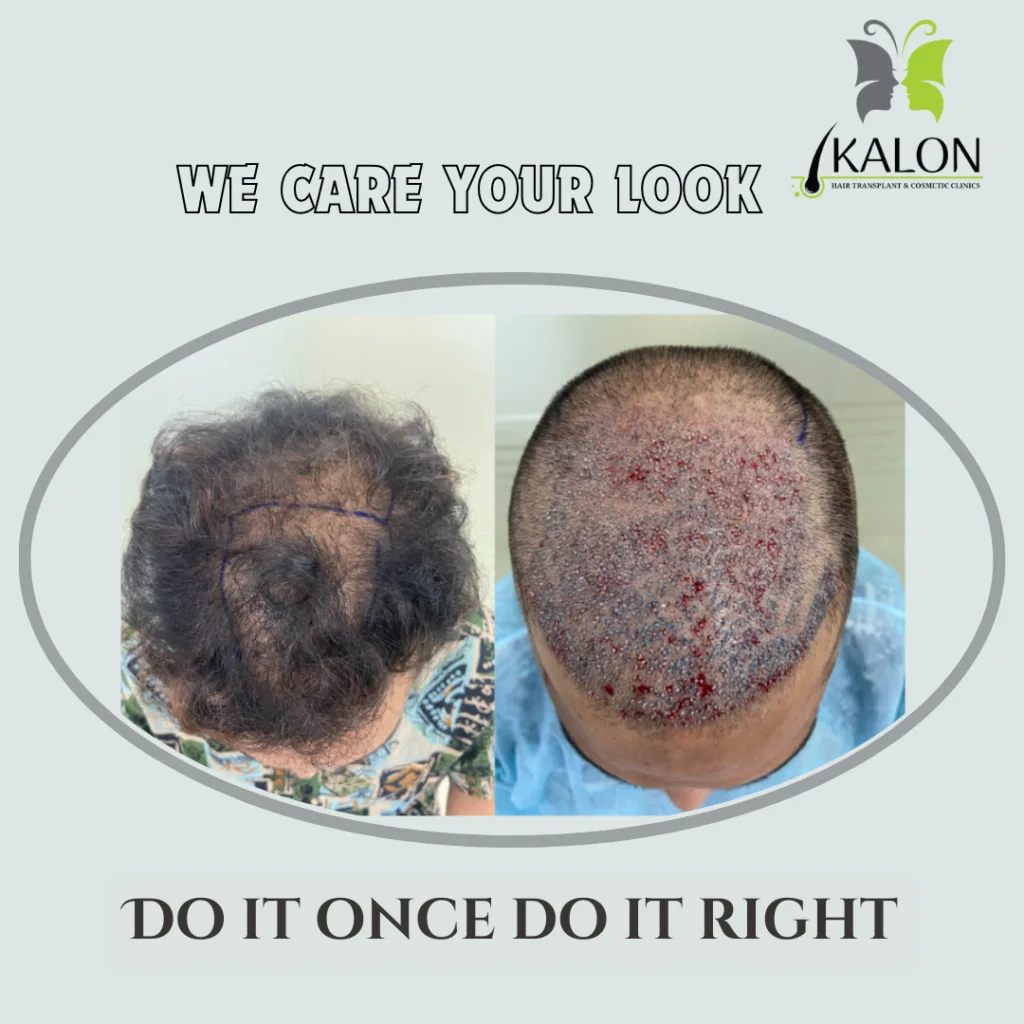 best hair transplant in visakhapatnam