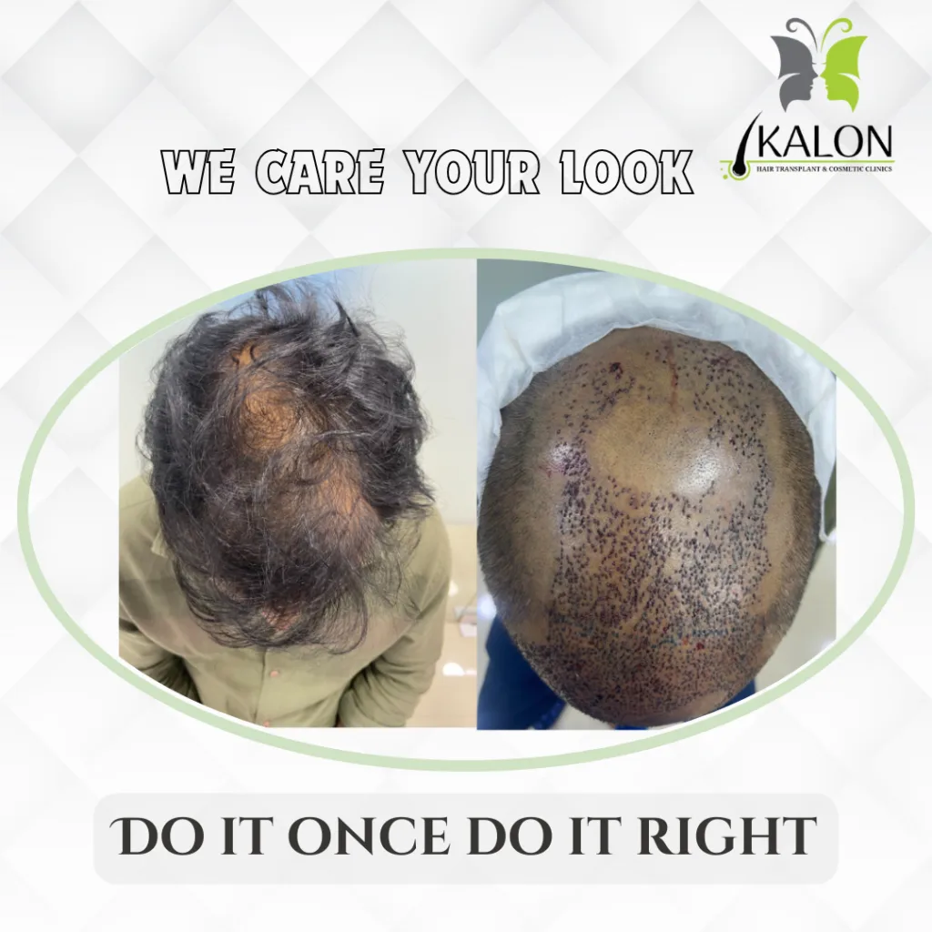 best hair transplant clinic in hyderabad