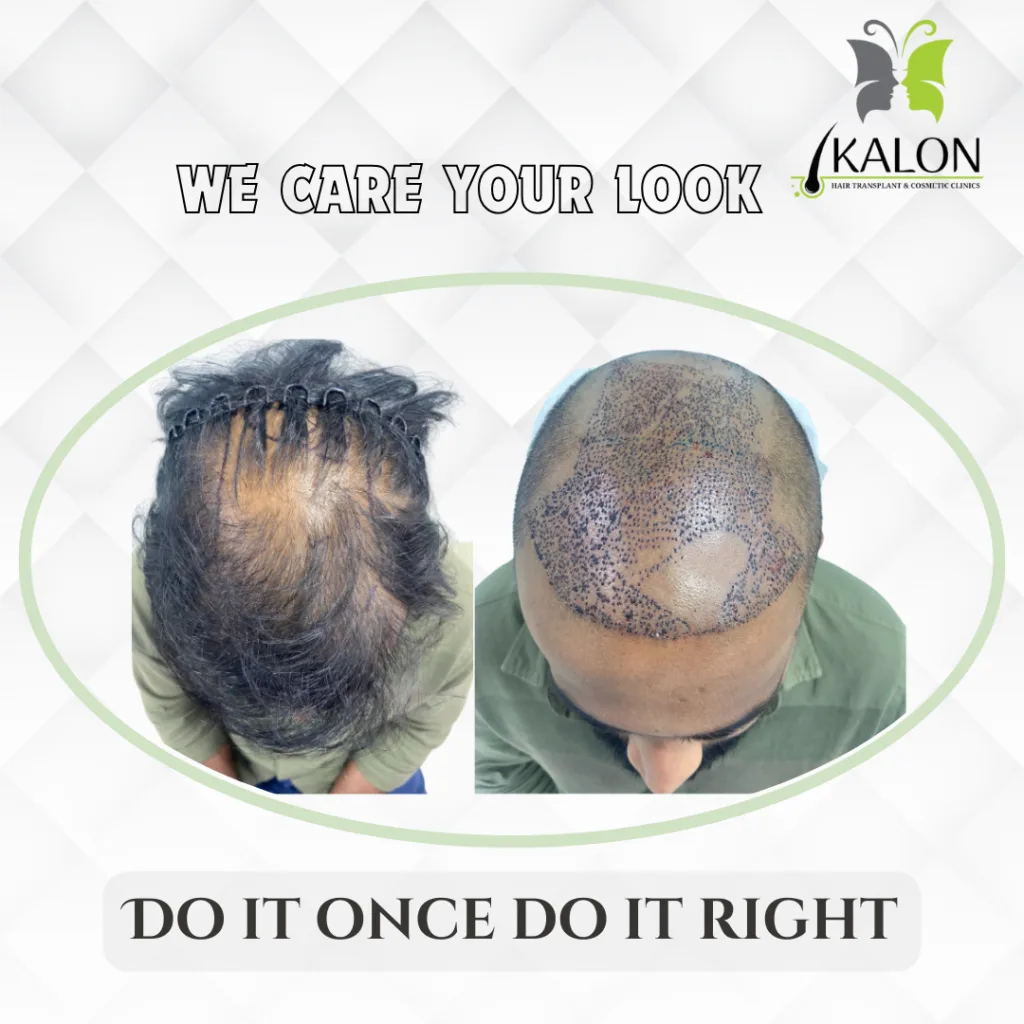 best hair transplant clinic in hyderabad