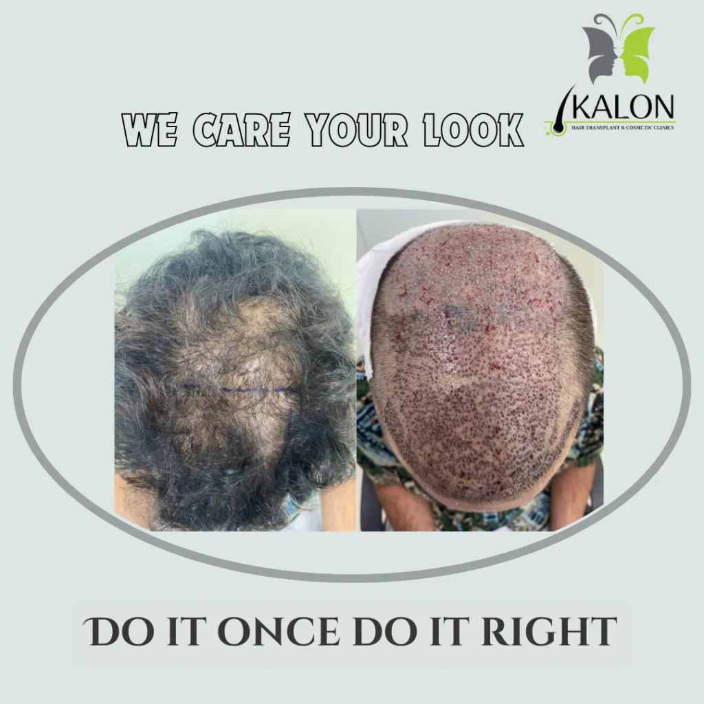 best hair transplant in visakhapatnam