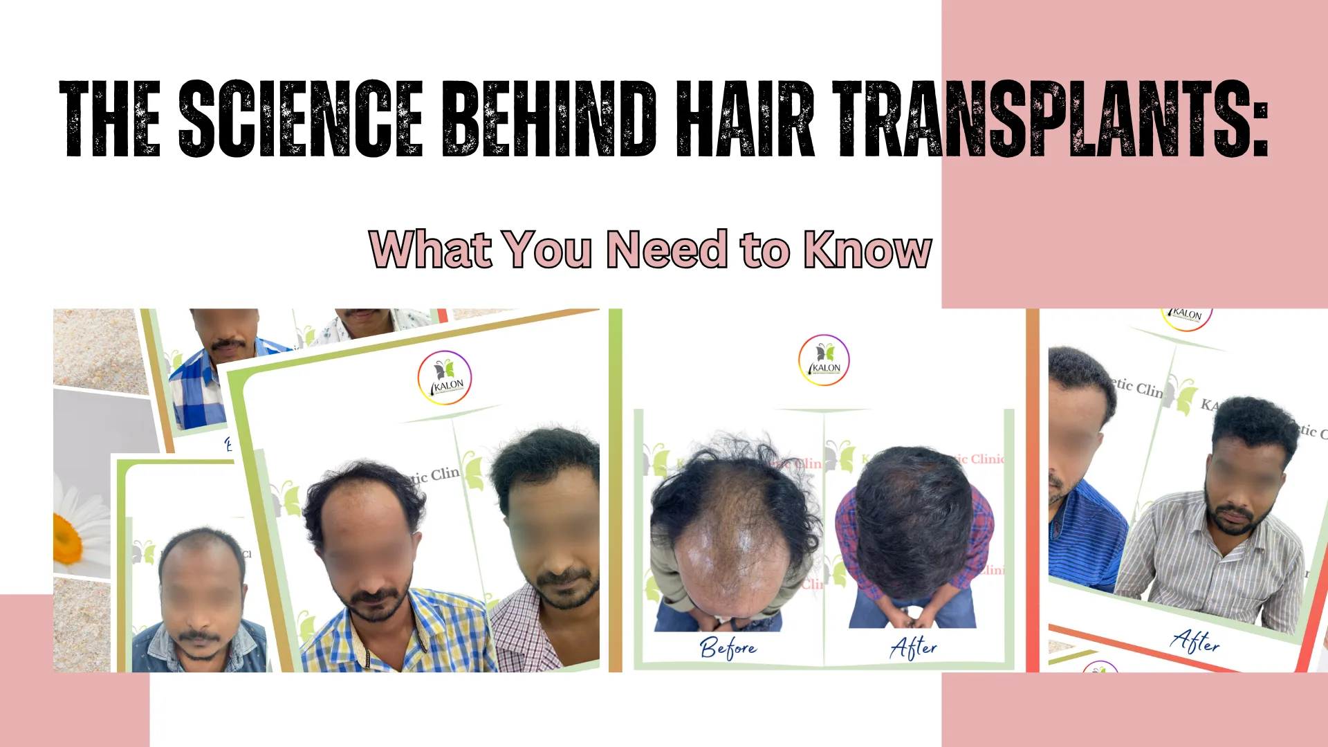 best hair transplant clinic in visakhapatnam