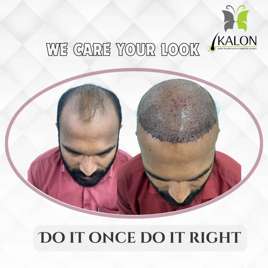 hair transplant