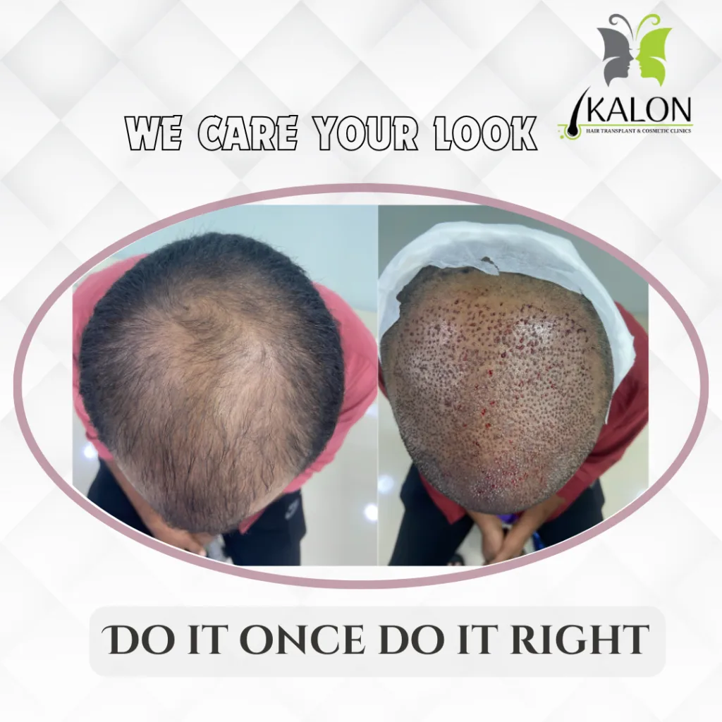 hair transplant