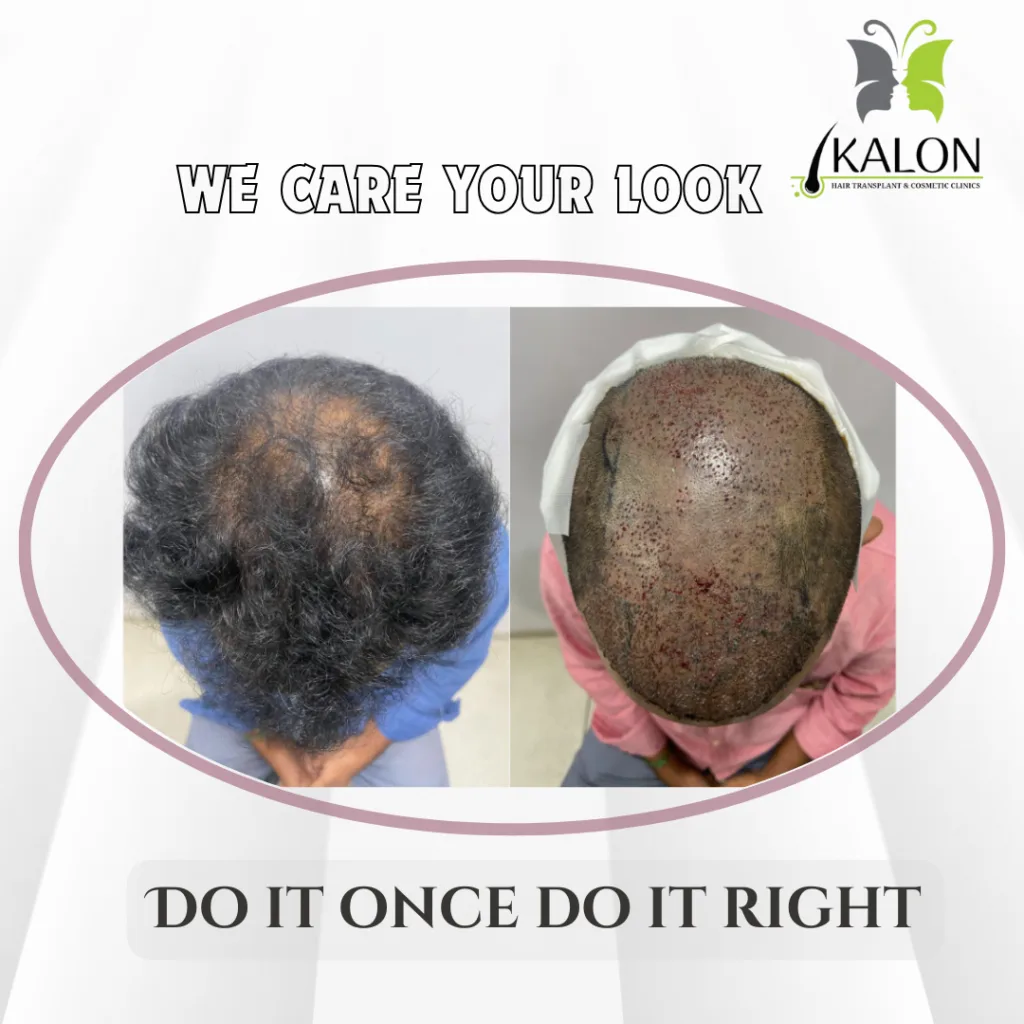 hair transplant