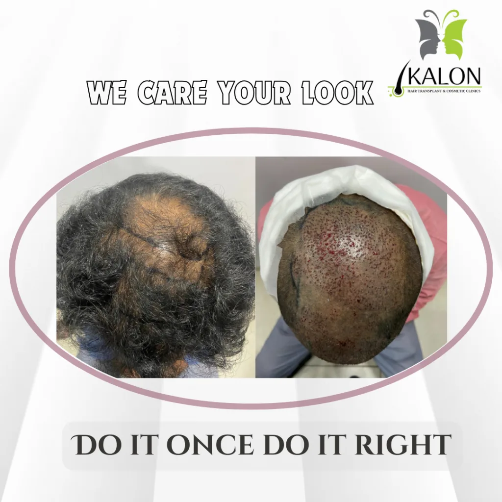 hair transplant