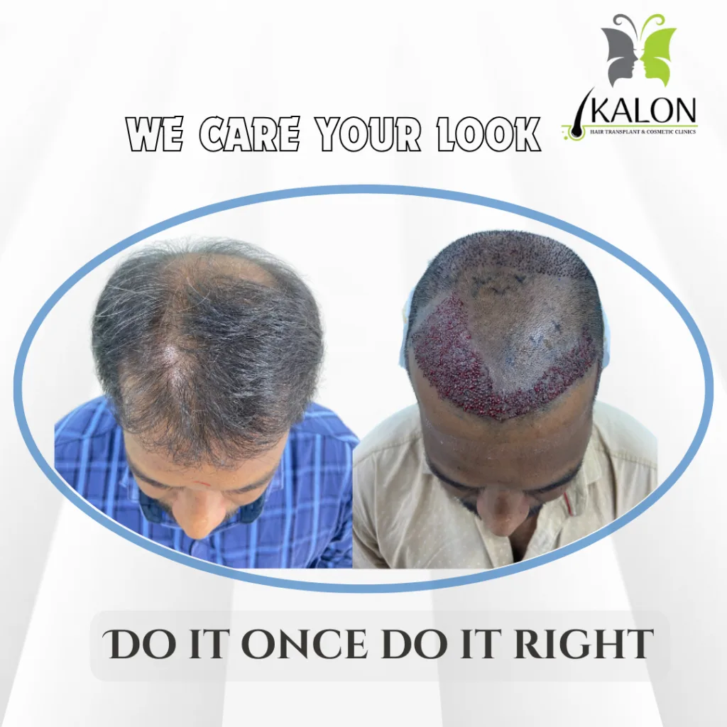 hair transplant