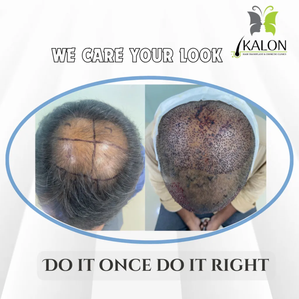 hair transplant