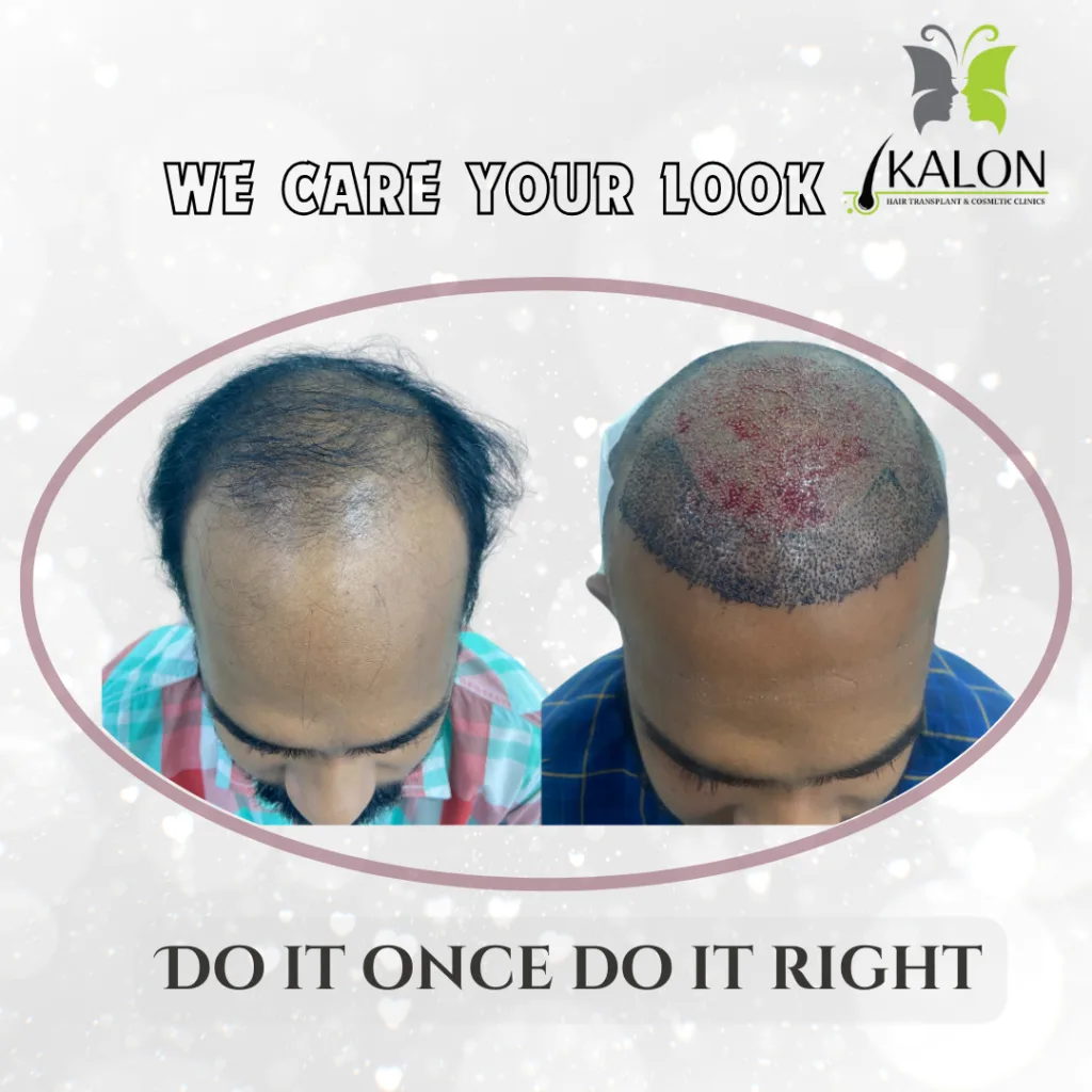 best hair transplant clinic in visakhapatnam
